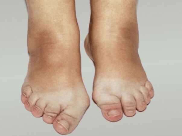 Arthrose des Fußes mit starker Verformung der Zehen. 