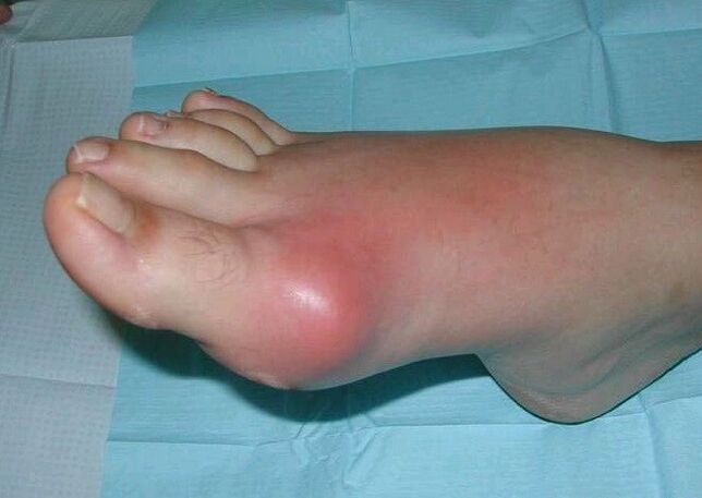 Klinisches Bild einer Fußarthritis mit Schwellung und Entzündung. 