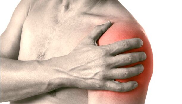 Eine geschwollene, rote, vergrößerte Schulter zeigt Symptome einer Arthrose des Schultergelenks Grad 2-3