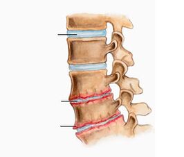 Osteochondrose