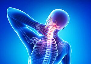 Anzeichen einer zervikalen Osteochondrose