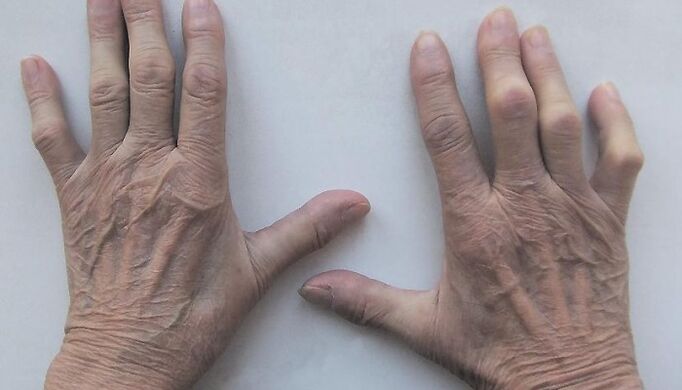 Schmerzen im Fingergelenk