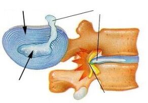 Zerstörung des Anulus fibrosus bei zervikaler Osteochondrose