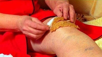 Komprimiert für die Arthrose des Kniegelenks
