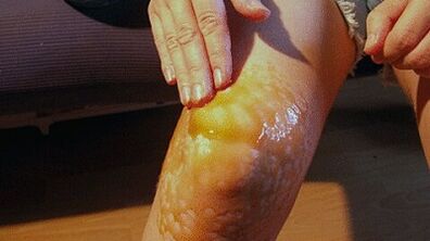 Roben zur Behandlung von Arthrose des Kniegelenks