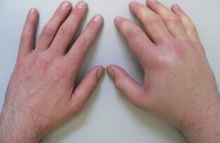Arthralgie als Schmerzursache in den Fingergelenken