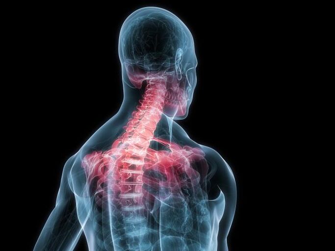 Die Osteochondrose der Halswirbelsäule ist eine Modifikation der Bandscheiben. 