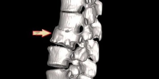 Wirbelsäulenpathologie als Ursache von Rückenschmerzen