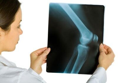 Behandlung der Kniegelenks -Osteoarthritis