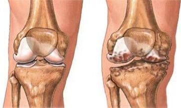 Knie -Arthrose