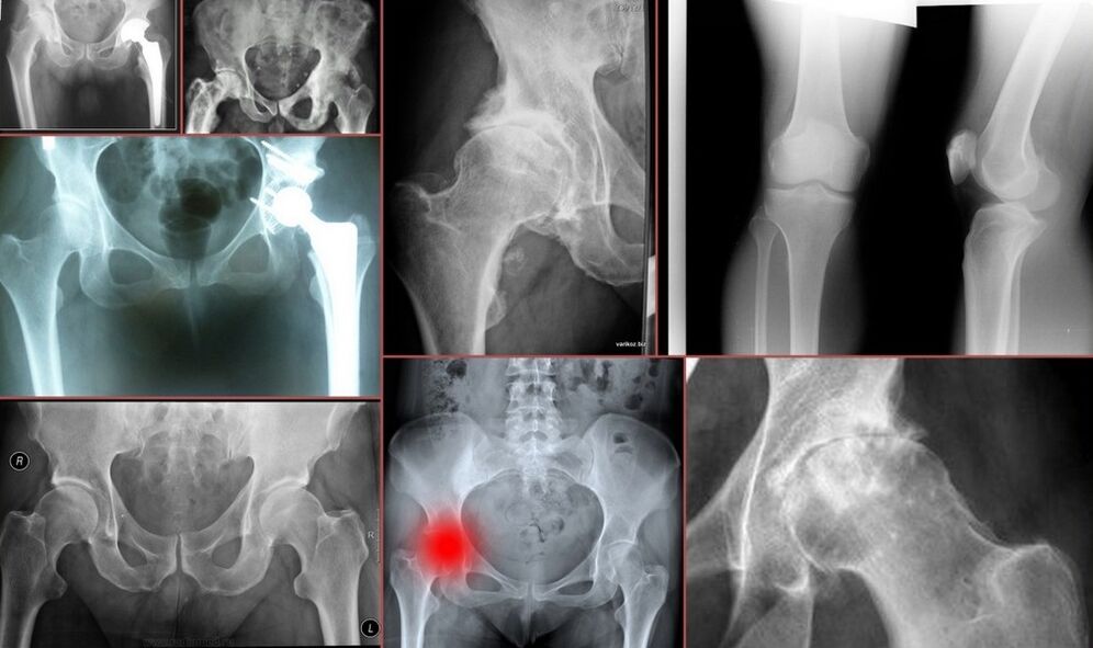 röntgen bei hüftschmerzen