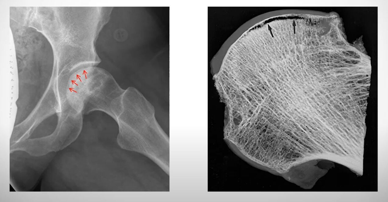 Röntgenaufnahme des von einer aseptischen Nekrose betroffenen Femurkopfes