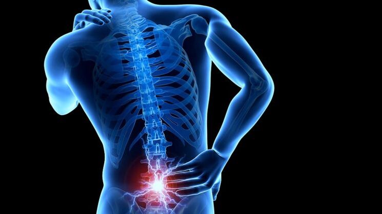 Rückenschmerzen mit lumbaler Osteochondrose